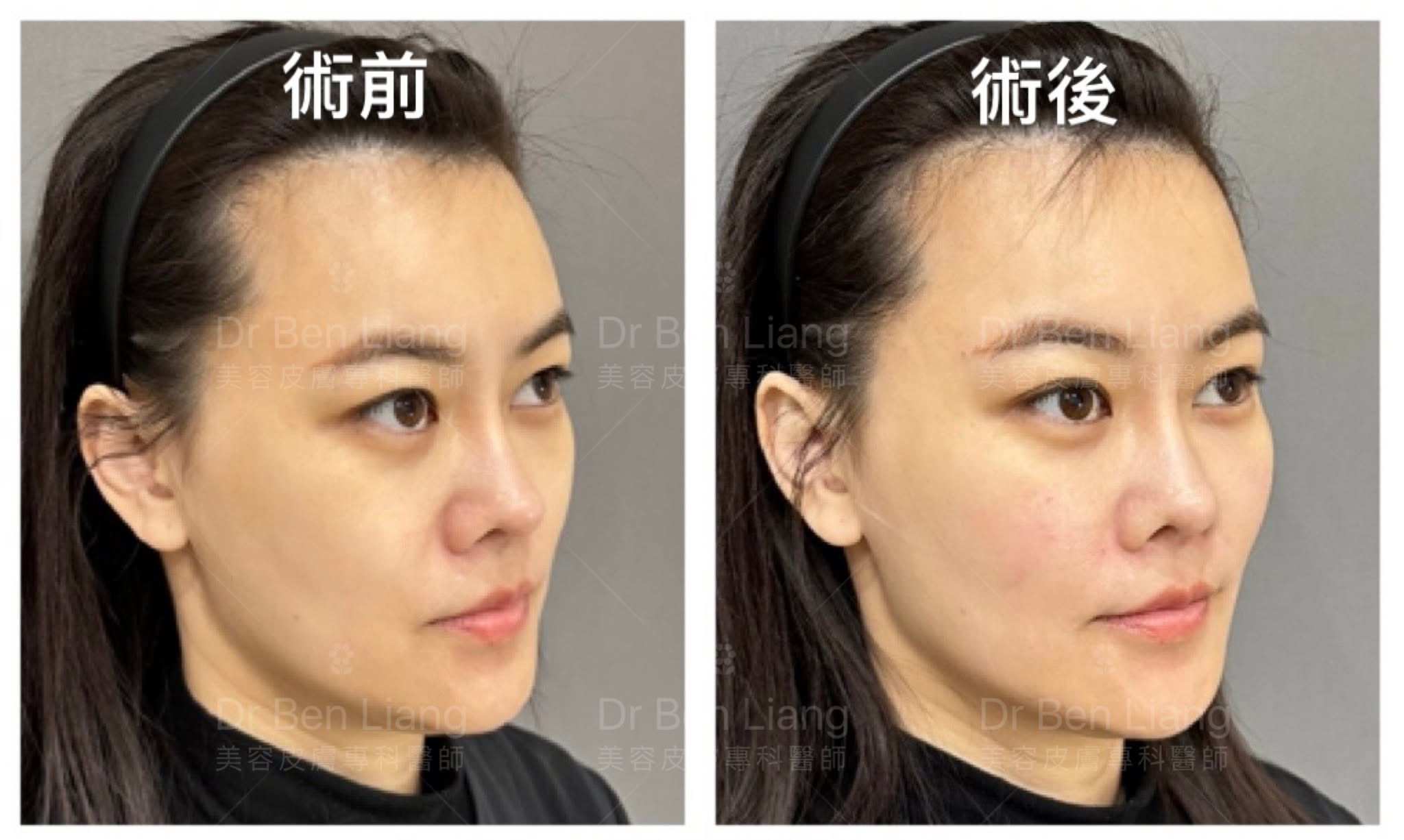 側臉術前術後太陽穴與輪廓比較